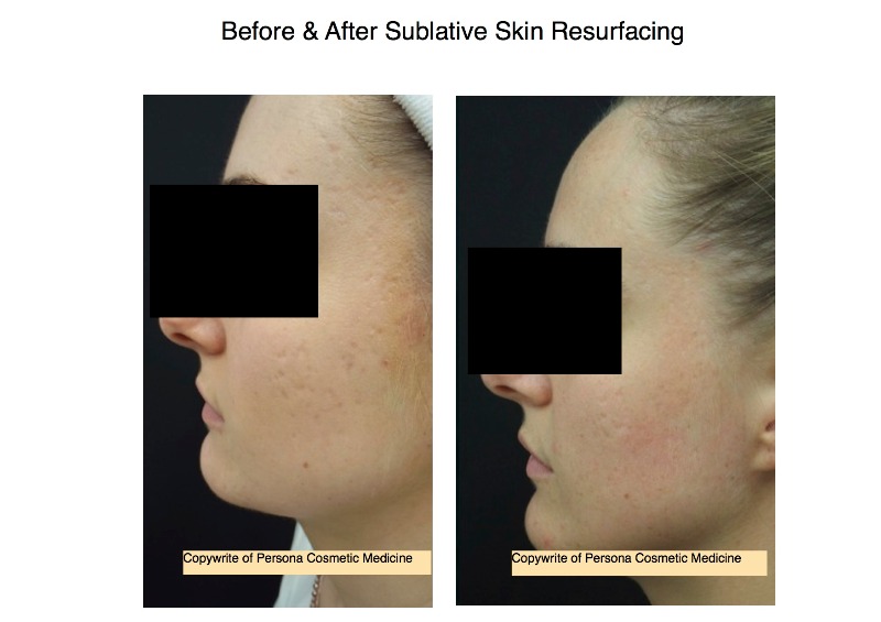 Sublative Rejuvenation